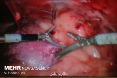 قیمت ربات جراحی از دور ایرانی یك سوم نمونه آمریكایی است